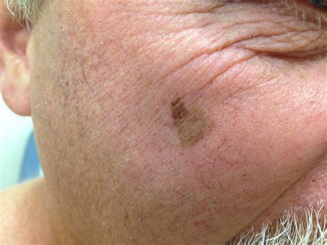 pictures of early stage melanoma on the face